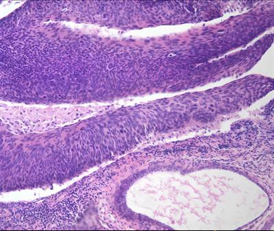 Case report: A case report of co-morbidity of cervical intraepithelial neoplasia III and urethral cancer associated with HPV16